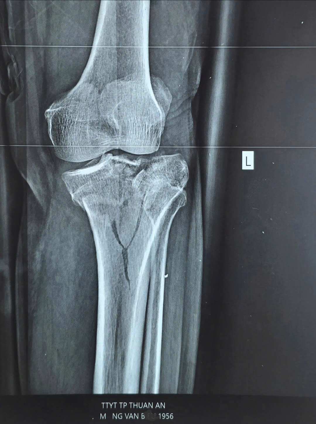 🏓 CHẤN THƯƠNG THƯỜNG GẶP KHI CHƠI PICKLEBALL.