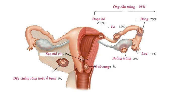 PHẪU THUẬT NỘI SOI THAI ĐOẠN KẼ (Interstitial ectopic pregnancy) TẠI TRUNG TÂM Y TẾ KHU VỰC THUẬN AN