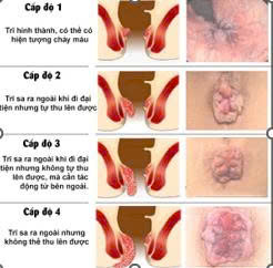 BỆNH TRĨ – PHÁT HIỆN SỚM, ĐIỀU TRỊ HIỆU QUẢ TẠI TTYT KHU VỰC THUẬN AN