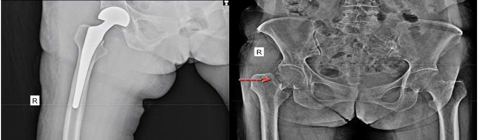 PHÒNG NGỪA TÉ NGÃ Ở NGƯỜI CAO TUỔI – TRÁNH GÃY CỔ XƯƠNG ĐÙI, PHẢI THAY KHỚP HÁNG