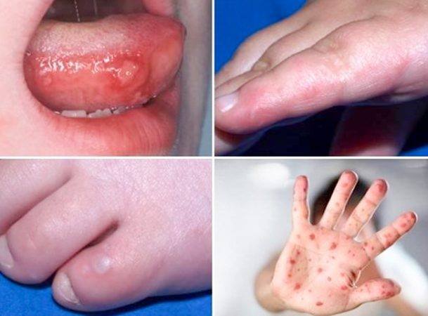 Trẻ mắc tay chân miệng chỉ sốt, loét miệng, không có nhiều mụn nước vẫn có nguy cơ diễn biến nặng nhanh chóng