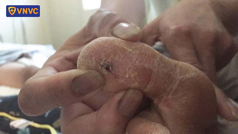 nhiễm trùng uốn ván