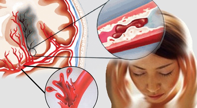Cảnh giác đột quị não khi giao mùa