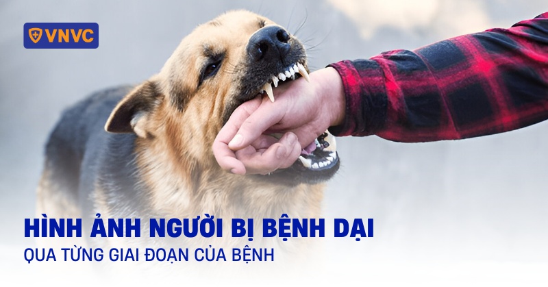Hình ảnh người bị bệnh dại qua từng giai đoạn của bệnh