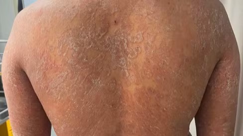 Sai lầm trong điều trị nấm da, bệnh da bùng phát khắp cơ thể