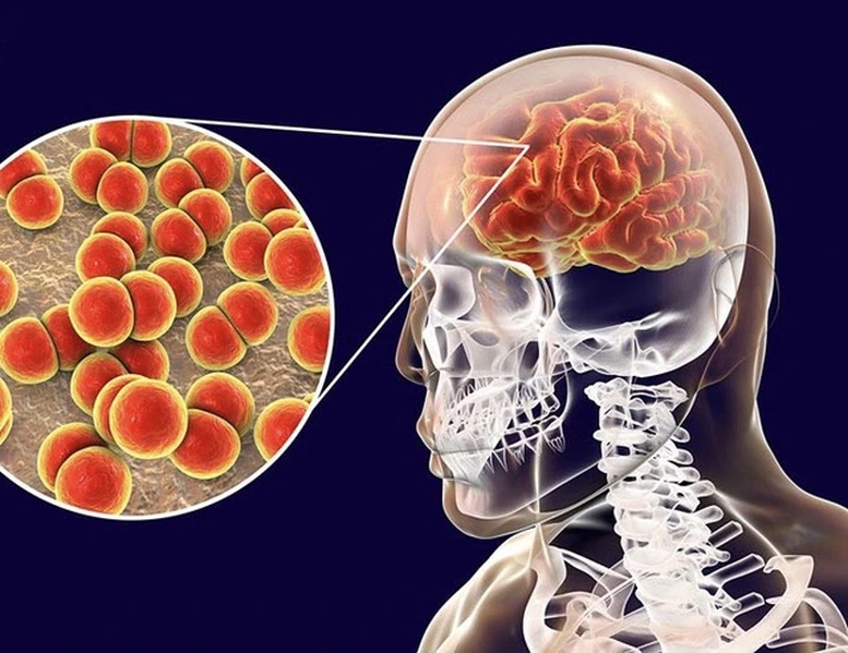 Ca bệnh do não mô cầu gia tăng