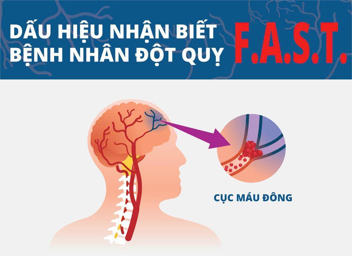Chủ động kiểm soát và phòng tránh đột quỵ