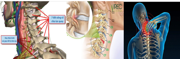 HỘI CHỨNG ĐAU VAI GÁY