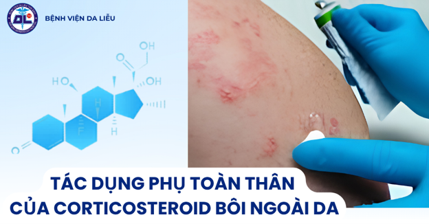 TÁC DỤNG PHỤ TOÀN THÂN CỦA CORTICOSTEROID  BÔI NGOÀI DA