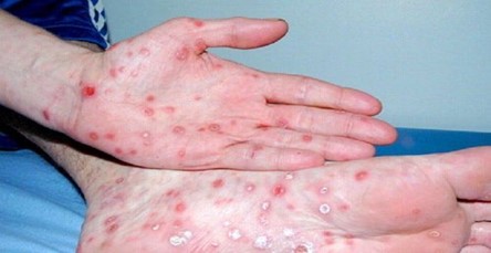 HIỂU ĐÚNG VỀ BỆNH GIANG MAI ĐỂ BẢO VỆ SỨC KHỎE  BẢN THÂN VÀ GIA ĐÌNH  ​