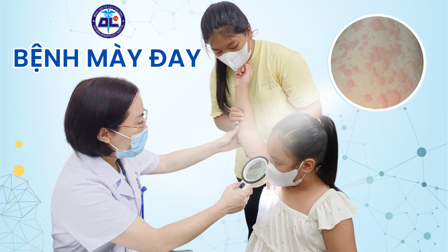 Mày đay – Những điều cần biết.