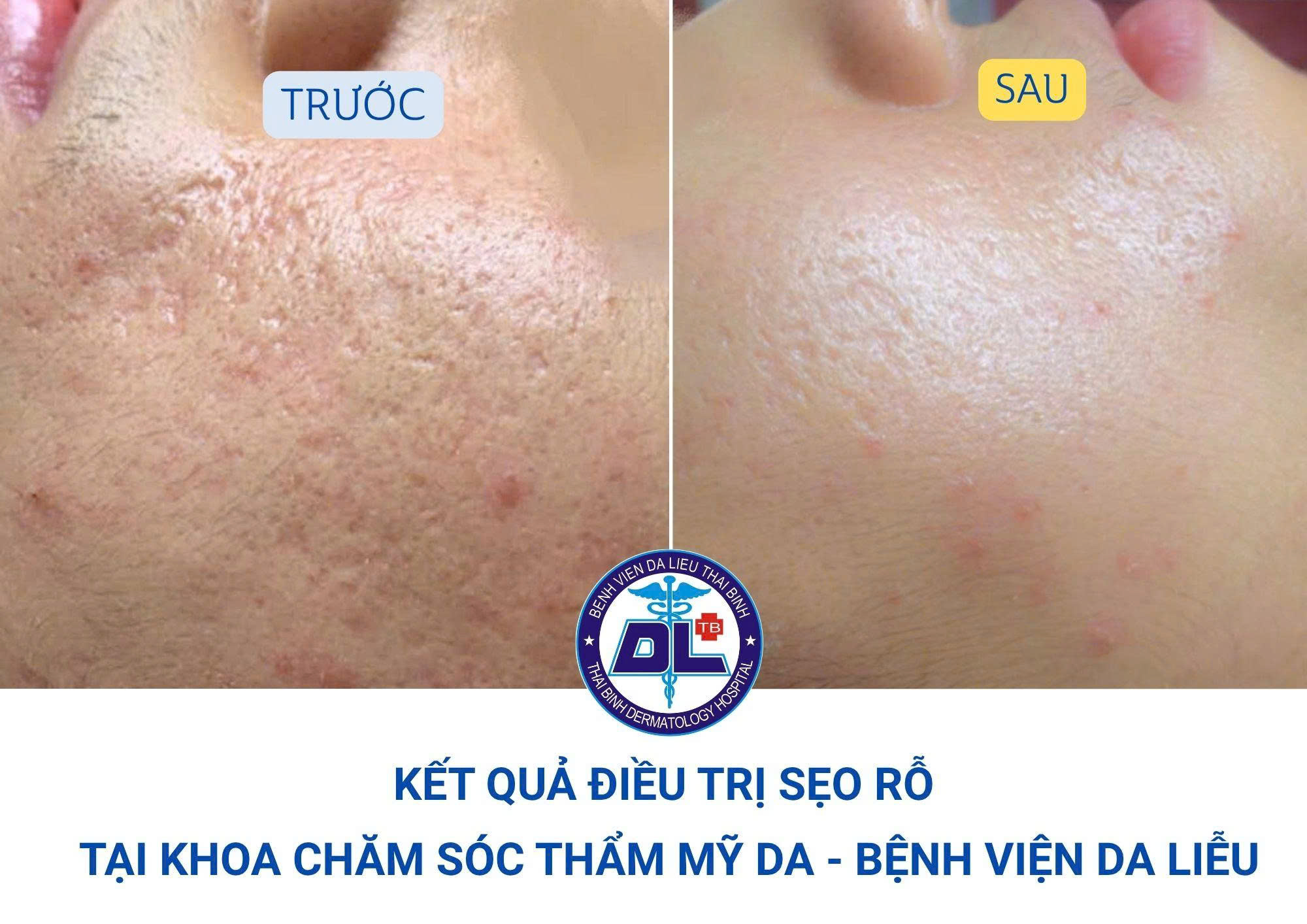 SẸO RỖ KHÔNG PHẢI DO… NẶN MỤN MÀ DO VIÊM PHÁ HUỶ  CẤU TRÚC DA
