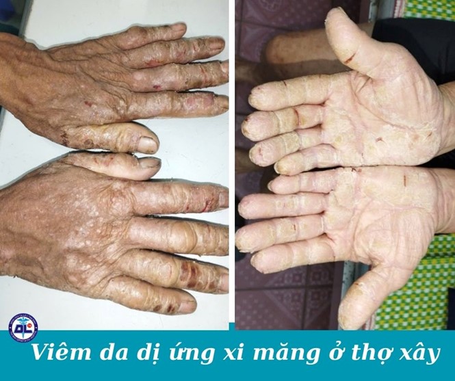 VIÊM DA TIẾP XÚC DỊ ỨNG