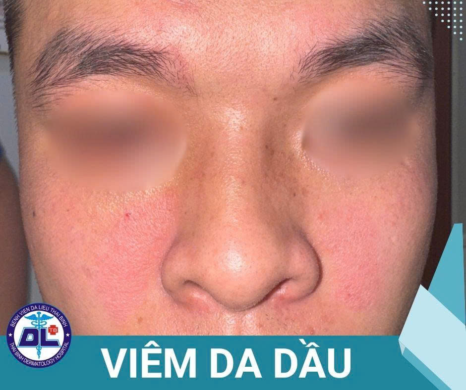 VIÊM DA DẦU: HIỂU ĐÚNG ĐỂ SỐNG KHỎE CÙNG LÀN DA  KHÔNG LO BONG TRÓC!