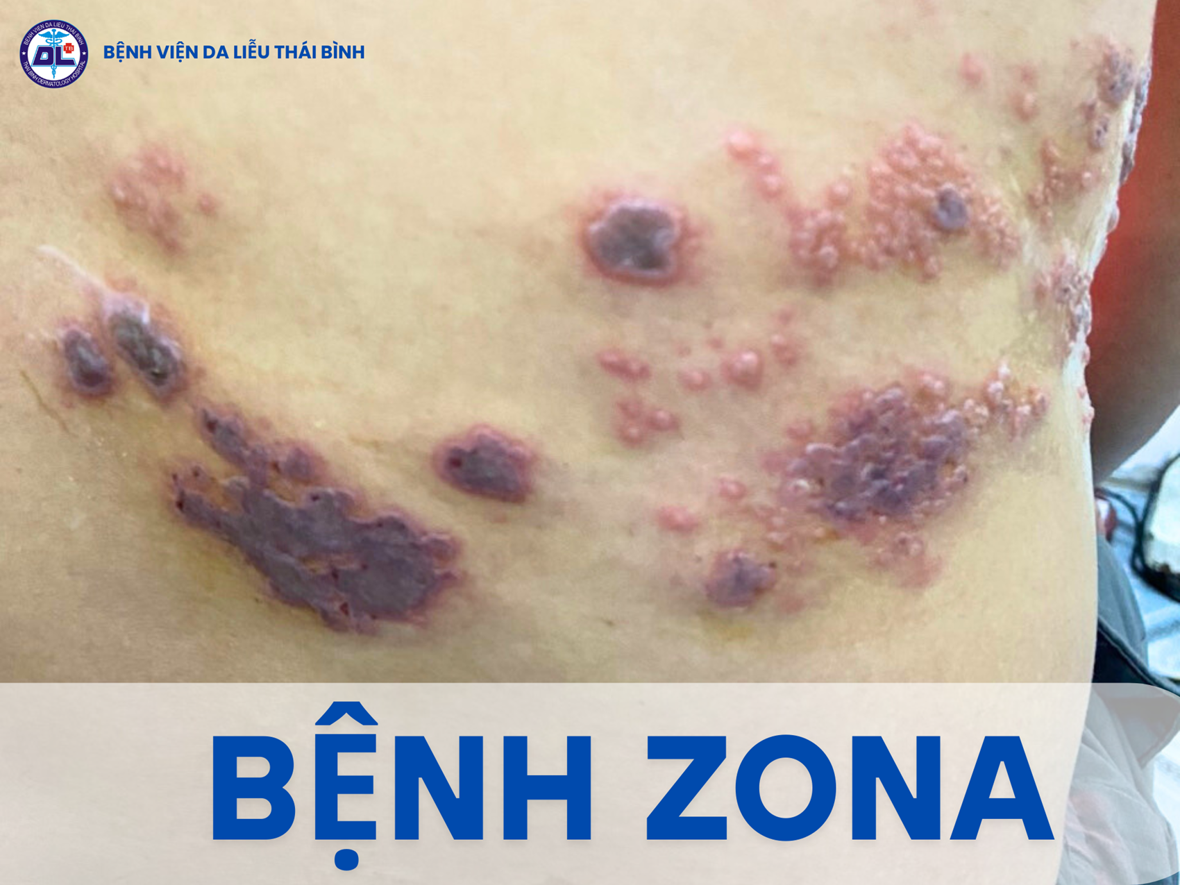 Bệnh Zona: Nguyên nhân, triệu chứng và cách điều trị.