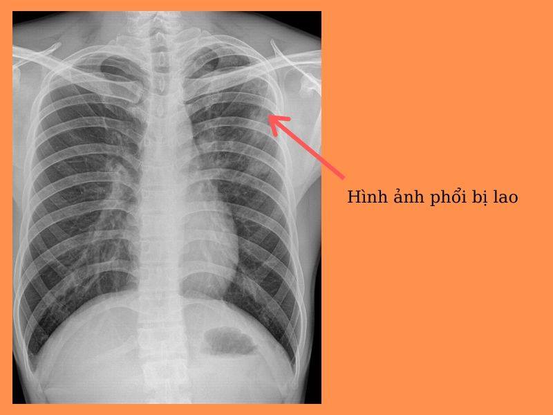 Hội Nông dân Việt Nam chung tay đẩy lùi bệnh lao